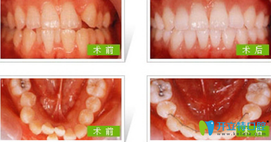 成人可以矫正牙齿吗？成人优米手机官网app有哪些方法？