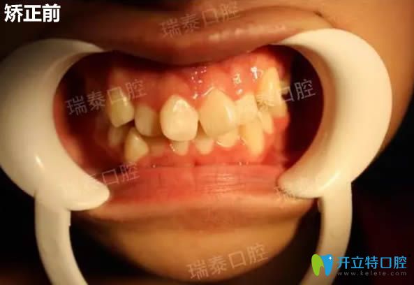 记录我去西安瑞泰口腔做时代天使隐形矫正14个月以来的感受
