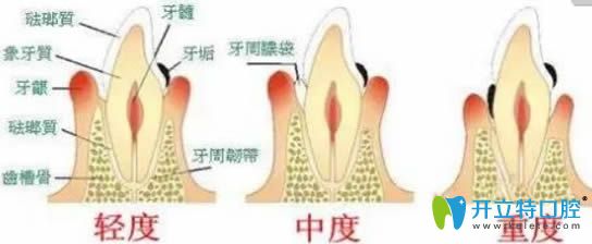 牙龈萎缩怎么办该怎样治疗?萎缩的牙龈还能长回来吗