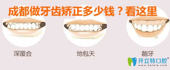 成都做优米手机官网app多少钱?看时代天使/隐适美/正雅牙套价格表