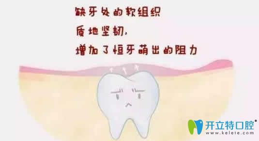 请问大家埋伏牙一定要拔吗不拔有什么危害