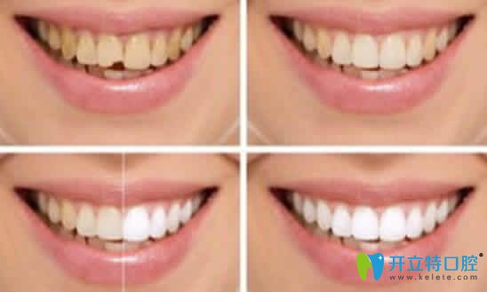 牙齿做冷光美白前后对比照 牙齿做冷光美白前后对比照