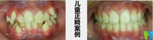 成都君臣儿童正畸案例及前后对比照