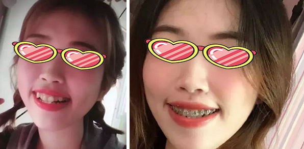 看福州东南口腔的传统金属牙套 怎样驯服我的小龅牙