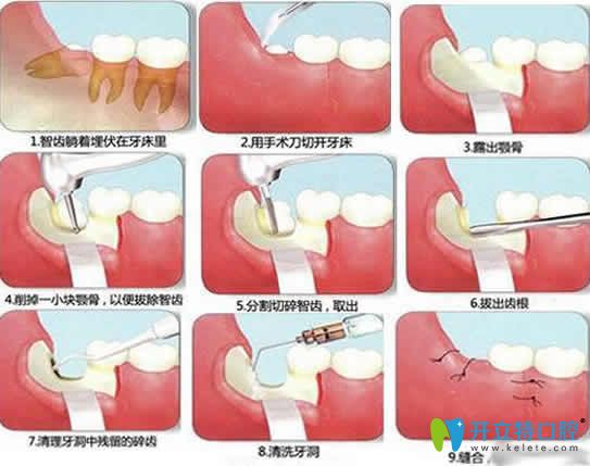 拔智慧牙过程图