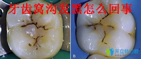 牙齿窝沟黑线怎样能去除 光固化树脂补牙缝及补牙价格分享