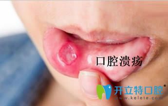 开立特引起复发性口腔溃疡原因是什么 开立特引起复发性口腔溃疡原因是什么