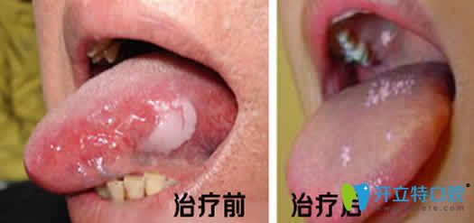 口腔黏膜白斑治疗前后效果对比 口腔黏膜白斑治疗前后效果对比