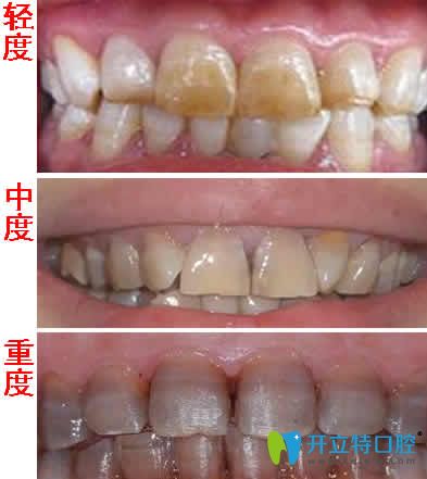 分享:四环素牙不同程度的图片及四环素牙是怎么形成的