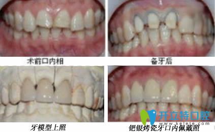 银钯烤瓷牙图片 银钯烤瓷牙图片
