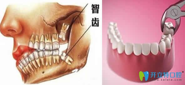 智齿拔后疼多久算正常 智齿拔后疼多久算正常