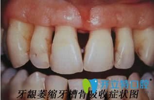 医生:我年纪轻轻就牙龈萎缩牙槽骨吸收该怎么治疗和预防呢?