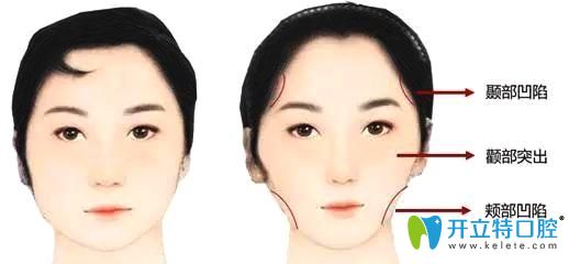 优米手机官网app中牙套脸是怎么形成的？什么脸型容易出现牙套脸