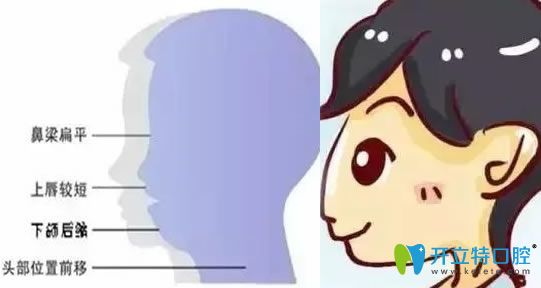 今日分享习惯性口腔呼吸有什么危害及用嘴巴呼吸怎么改正