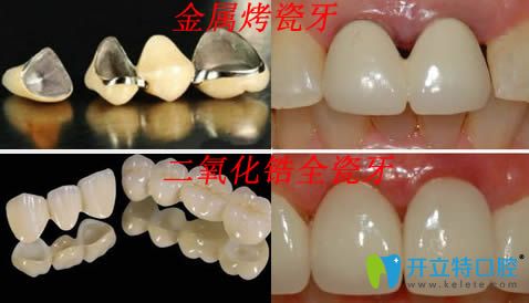 二氧化锆全瓷牙和金属烤瓷牙区别图片 二氧化锆全瓷牙和金属烤瓷牙区别图片