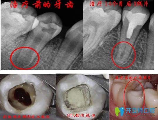 年轻恒牙牙髓再生术治疗效果图 年轻恒牙牙髓再生术治疗效果图