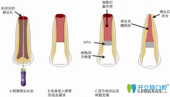 牙髓血管再生术治疗过程图解 牙髓血管再生术治疗过程图解