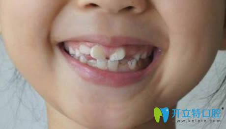 小孩新换的恒牙长歪了怎么办?恒牙长歪会自动调整归位吗?