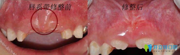 上唇系带修整术前后对比图 上唇系带修整术前后对比图