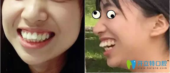 我比较了广州华美和美莱的牙套价格后,去华美做了龅牙矫正