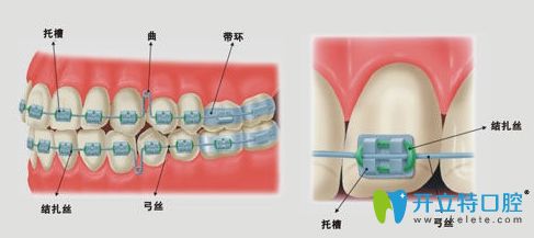 牙齿托槽掉了必须要马上粘接 牙齿托槽掉了必须要马上粘接