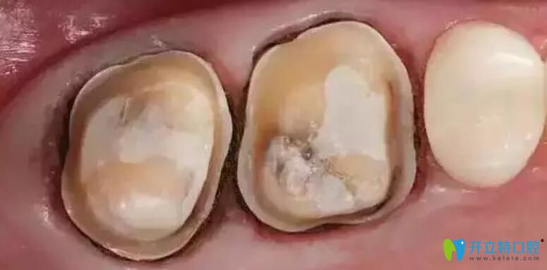 烤瓷牙什么样算不密合?烤瓷牙不密合什么感觉,该怎么补救?