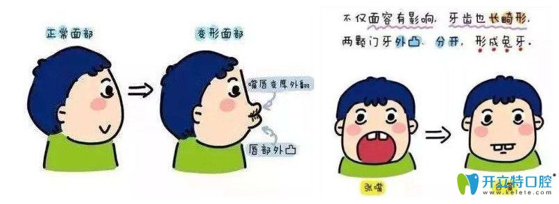 年纪轻轻嘴越来越突、法令纹加重？牙齿外突的真相与改善