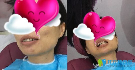 广州壹加壹口腔的全瓷牙贴面矫正了我的四环素黑黄牙