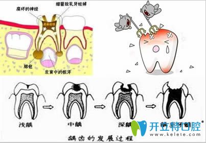 龋齿发展过程图解 龋齿发展过程图解