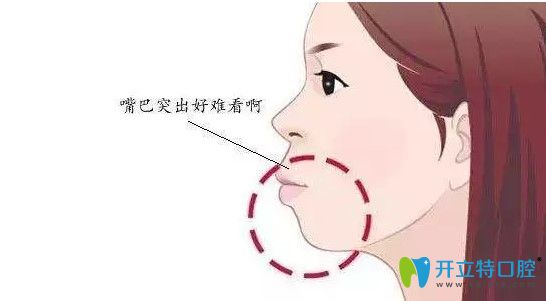牙齿不暴但是突嘴,解答骨性和牙性突嘴做矫正带牙套有用吗?