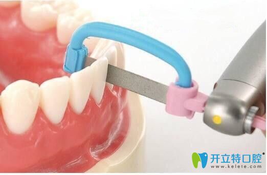 请看：正畸中邻面去釉对牙齿有危害吗？