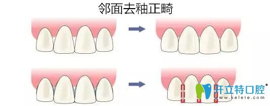 邻面去釉正畸效果 邻面去釉正畸效果