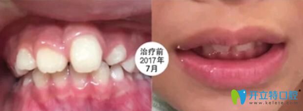  8岁儿子在成都河马口腔做MRC肌功能矫正6个月,成功改善歪牙