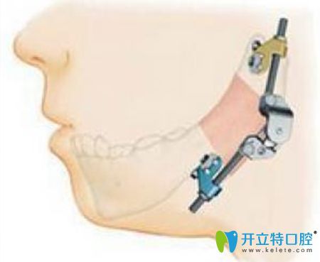 下巴错位别乱治!专业颞颌关节错位怎么复位的治疗方法在此