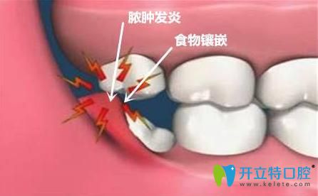 智齿冠周炎能自愈吗 智齿冠周炎能自愈吗