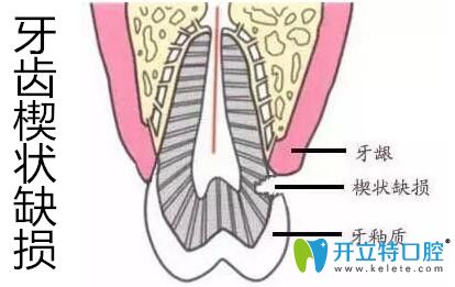 牙齿楔状缺损千万不要盲目补牙,先弄清楔状缺损的修复方法