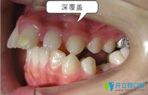 深覆盖牙齿症状图 深覆盖牙齿症状图