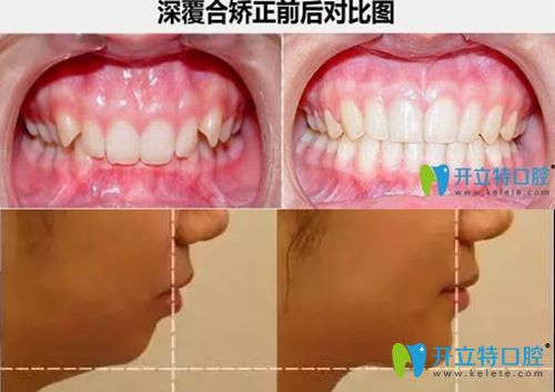 深覆颌矫正<span style= 深覆颌矫正<span style=