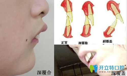 正常牙颌和深覆合及深覆盖对比图 正常牙颌和深覆合及深覆盖对比图