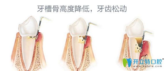 牙周病牙齿松动 牙周病牙齿松动