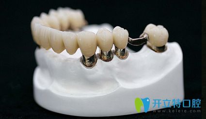 套筒冠义齿修复牙齿松动 套筒冠义齿修复牙齿松动