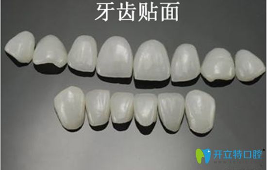 做超薄瓷贴面后悔是有原因的,说下我做牙齿贴面5年后的感受