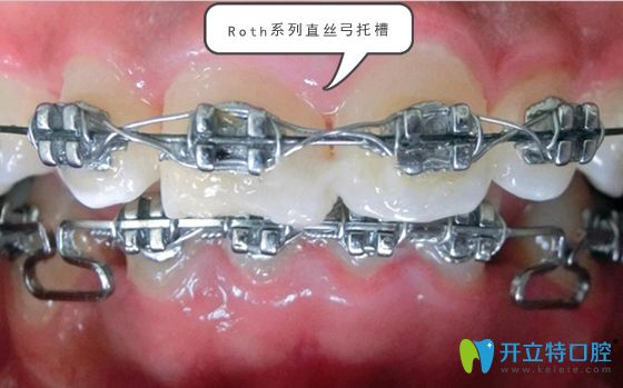 Roth系列直丝弓托槽 Roth系列直丝弓托槽