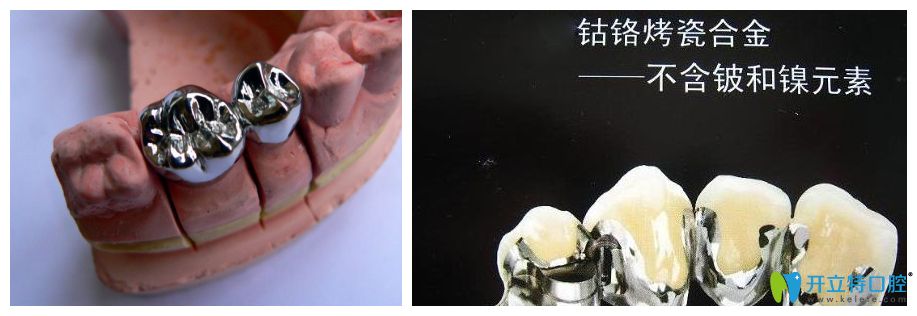 钢牙和钴铬烤瓷牙图示 钢牙和钴铬烤瓷牙图示