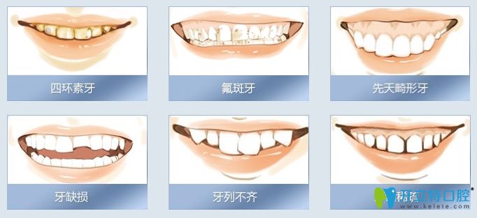 烤瓷牙适用人群 烤瓷牙适用人群