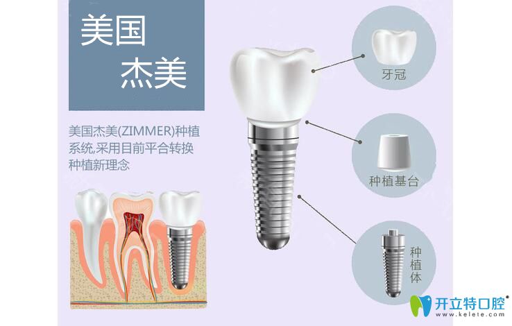 美国杰美种植体怎么样以及zimmer种植牙价格，让你5分钟悉知