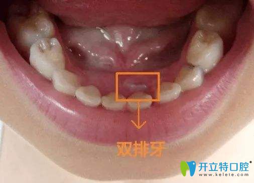 孩子长出双排牙只因为麻麻犯了一个错误你敢信？