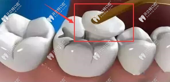补牙材料的大小不合适 补牙材料的大小不合适