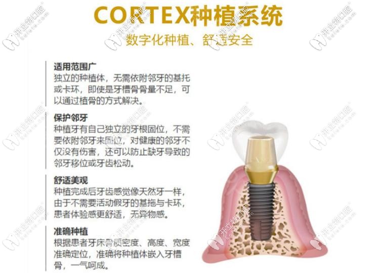 cortex种植体优势 cortex种植体优势
