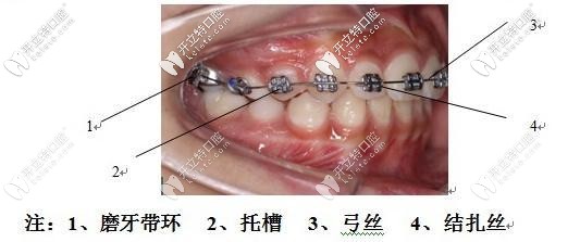 begg细丝弓矫治前牙拥挤 begg细丝弓矫治前牙拥挤